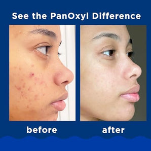 PanOxyl Acne Foaming Wash Benzoyl Peroxide 10% Maximum Strength Antimicrobial, 5.5 Oz